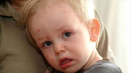 Những sai lầm nghiêm trọng mà phụ huynh cần tránh khi chăm sóc trẻ bị sốt xuất huyết