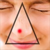 Nặn mụn vùng 'tam giác tử thần' trên mặt có thể gây tử vong