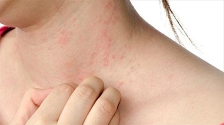 Rét đậm rét hại khiến nhiều người khốn khổ vì các chứng bệnh về da