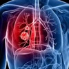 Ung thư phổi: Các dấu hiệu và triệu chứng cảnh báo tuyệt đối không nên bỏ qua