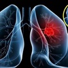 Chuyên gia giải đáp nguyên nhân vì sao bệnh ung thư phổi đang dần trẻ hóa