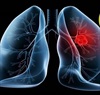 Chuyên gia giải đáp nguyên nhân vì sao bệnh ung thư phổi đang dần trẻ hóa