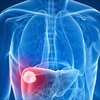 Nhận biết 5 loại ung thư đường tiêu hóa nguy hiểm và cách phòng ngừa