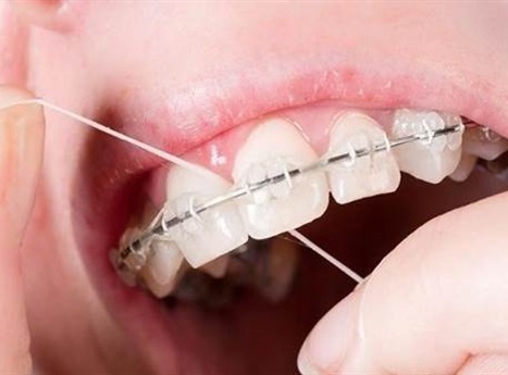 Người niềng răng cần lưu ý 5 vấn đề này để bảo vệ sức khỏe răng miệng